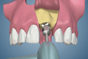 Immediate Implant Placement-Minimal Voids